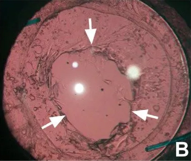 An-eye-with-posterior-capsule-opacification-before-A-and-after-Nd-YAG-posterior-2880w-02