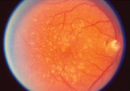 Clinical-stages-of-age-related-macular-degeneration-AMD-Early-stage-AMD-shows-yellow_Early AMD